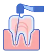 baby root canal image
